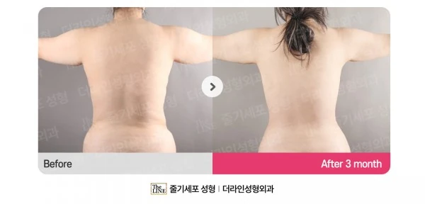 Abdomen + Corset Liposuction, before and after 3 months at Seoul Lipo Center