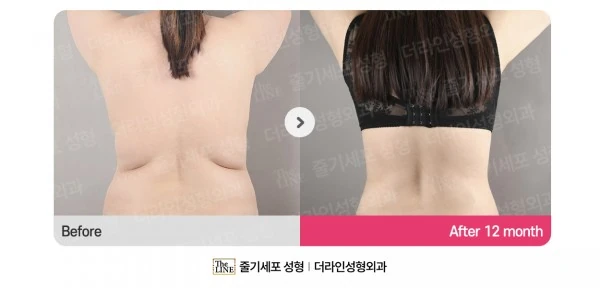 Abdomen + Corset Liposuction, before and after 1 year at Seoul Lipo Center