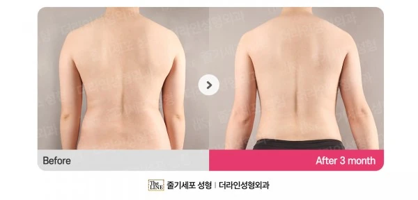 Abdomen + Corset Liposuction, before and after 3 months at Seoul Lipo Center