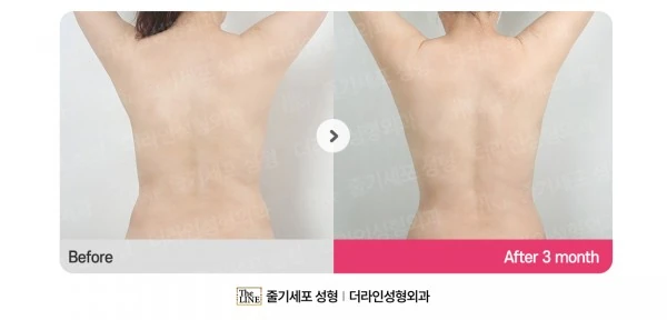 Abdomen + Corset Liposuction, before and after 3 months at Seoul Lipo Center