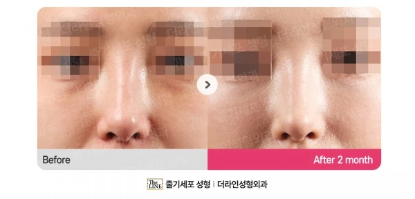 Rhinoplasty - Nasal Tip Surgery before-and-after photo, before surgery - TheLINE Plastic Surgery