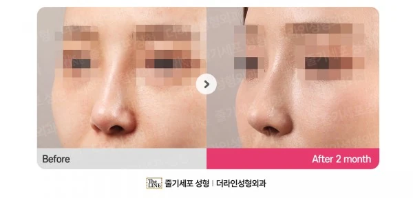 Rhinoplasty - Nasal Tip Surgery before-and-after photo, before surgery - TheLINE Plastic Surgery