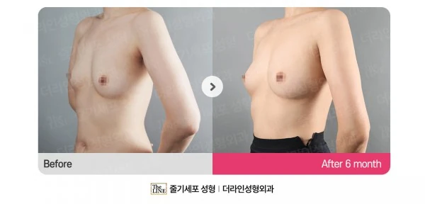Breast Fat Grafting before-and-after photo, before surgery - TheLINE Plastic Surgery