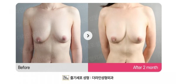 Breast Fat Grafting before-and-after photo, before surgery - TheLINE Plastic Surgery