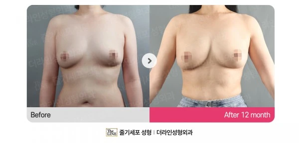 Breast Fat Grafting before-and-after photo, before surgery - TheLINE Plastic Surgery
