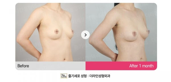Breast Fat Grafting before-and-after photo, before surgery - TheLINE Plastic Surgery