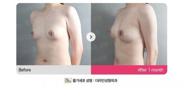 Breast Fat Grafting before-and-after photo, before surgery - TheLINE Plastic Surgery