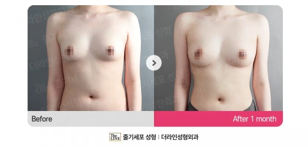 Breast Fat Grafting before-and-after photo, before surgery - TheLINE Plastic Surgery