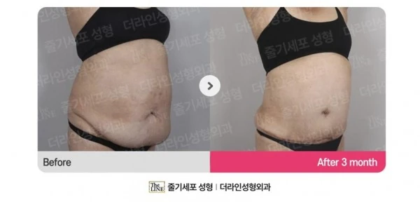 Abdominoplasty, Abdominal Lift before-and-after photo, before surgery - TheLINE Plastic Surgery