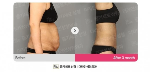 Abdominoplasty, Abdominal Lift + Abdomin before-and-after photo, before surgery - TheLINE Plastic Surgery