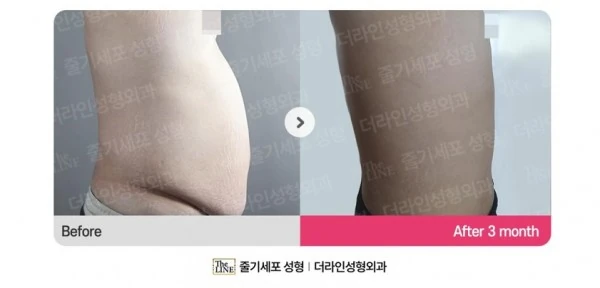Abdominoplasty, Abdominal Lift + Abdomin before-and-after photo, before surgery - TheLINE Plastic Surgery