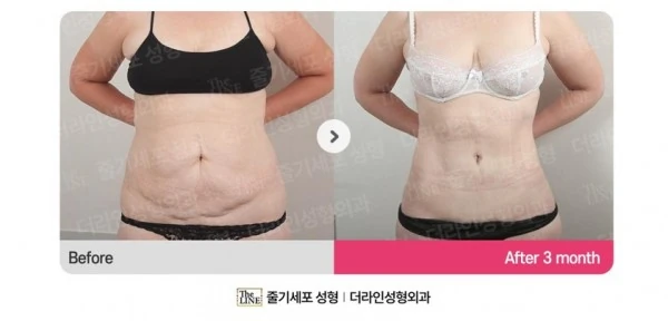 Abdominoplasty, Abdominal Lift + Abdomin before-and-after photo, before surgery - TheLINE Plastic Surgery