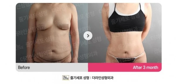 Abdominoplasty, Abdominal Lift + Abdomin before-and-after photo, before surgery - TheLINE Plastic Surgery