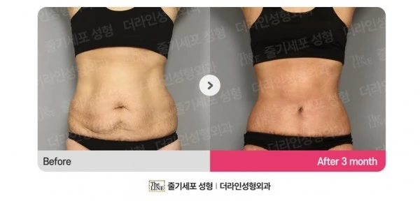 Abdominoplasty, Abdominal Lift + Abdomin before-and-after photo, before surgery - TheLINE Plastic Surgery