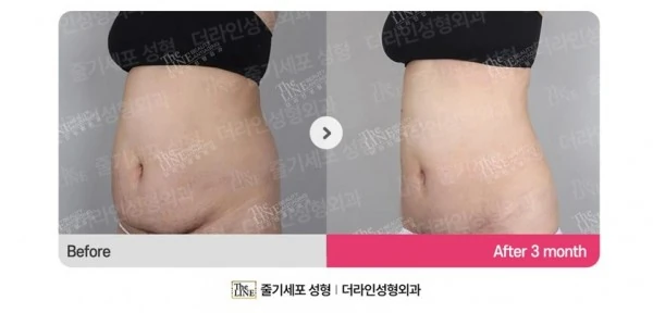 Abdominoplasty, Abdominal Lift + Abdomin before-and-after photo, before surgery - TheLINE Plastic Surgery
