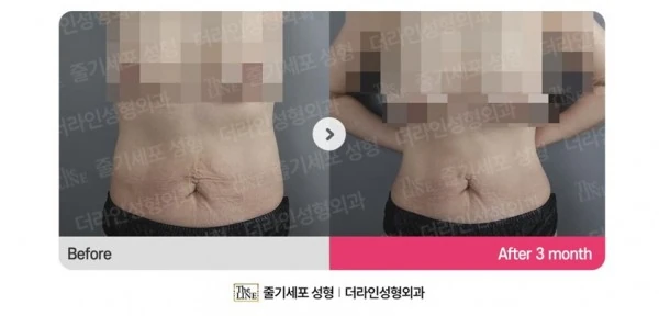 Abdominoplasty, Abdominal Lift + Abdomin before-and-after photo, before surgery - TheLINE Plastic Surgery