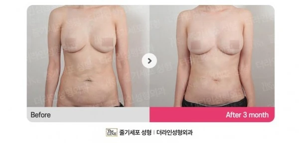 Abdominoplasty, Abdominal Lift + Abdomin before-and-after photo, before surgery - TheLINE Plastic Surgery