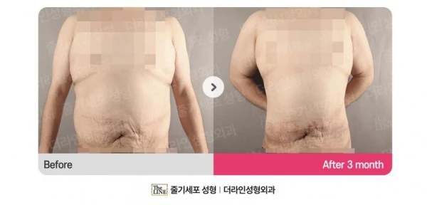 Abdominoplasty, Abdominal Lift + Abdomin before-and-after photo, before surgery - TheLINE Plastic Surgery