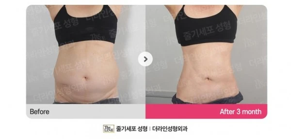 Abdominoplasty, Abdominal Lift + Abdomin before-and-after photo, before surgery - TheLINE Plastic Surgery