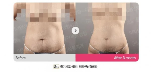 Abdominoplasty, Abdominal Lift + Abdomin before-and-after photo, before surgery - TheLINE Plastic Surgery