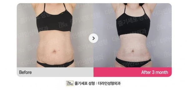 Abdominoplasty, Abdominal Lift + Abdomin before-and-after photo, before surgery - TheLINE Plastic Surgery