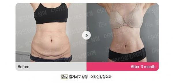 Abdominoplasty, Abdominal Lift + Abdomin before-and-after photo, before surgery - TheLINE Plastic Surgery