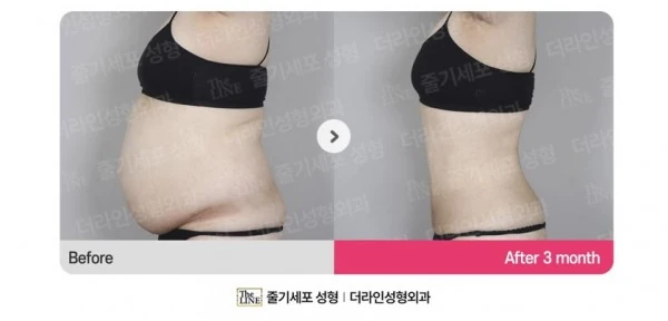 Abdominoplasty, Abdominal Lift + Abdomin before-and-after photo, before surgery - TheLINE Plastic Surgery