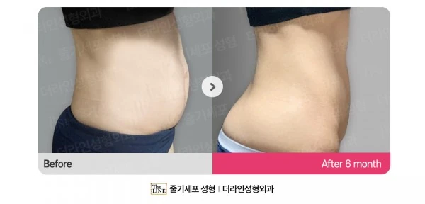 Abdominoplasty, Abdominal Lift + Abdomin before-and-after photo, before surgery - TheLINE Plastic Surgery