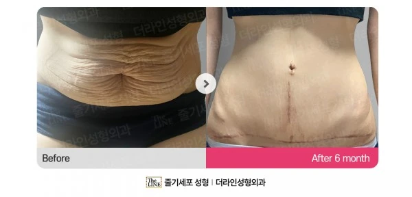Abdominoplasty, Abdominal Lift + Abdomin before-and-after photo, before surgery - TheLINE Plastic Surgery