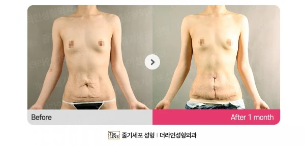 Abdominoplasty, Abdominal Lift before-and-after photo, before surgery - TheLINE Plastic Surgery