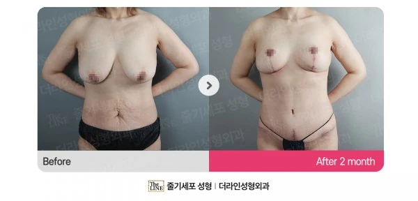 Abdominoplasty, Abdominal Lift + Breast before-and-after photo, before surgery - TheLINE Plastic Surgery