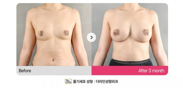 Breast Implants before-and-after photo, before surgery - TheLINE Plastic Surgery