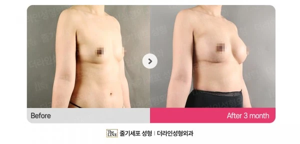 Breast Implants before-and-after photo, before surgery - TheLINE Plastic Surgery