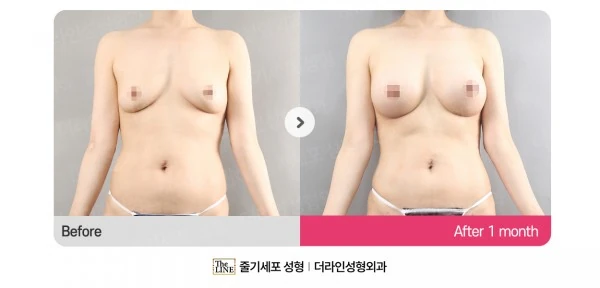 Breast Implants before-and-after photo, before surgery - TheLINE Plastic Surgery