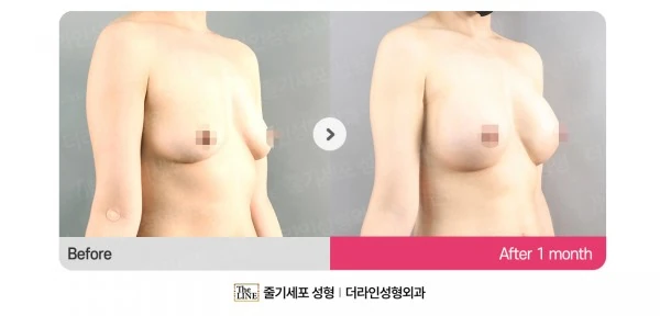 Breast Implants before-and-after photo, before surgery - TheLINE Plastic Surgery