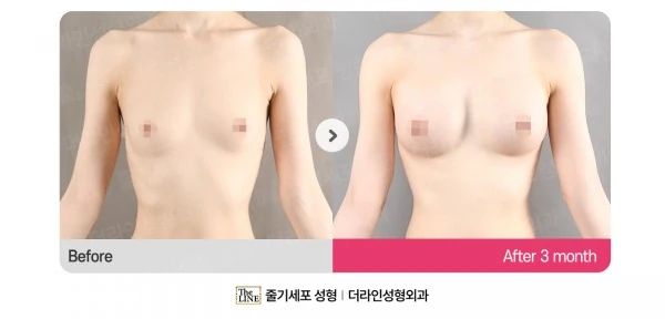 Breast Implants before-and-after photo, before surgery - TheLINE Plastic Surgery