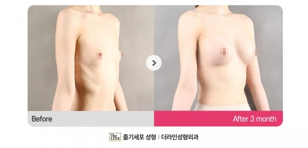 Breast Implants before-and-after photo, before surgery - TheLINE Plastic Surgery