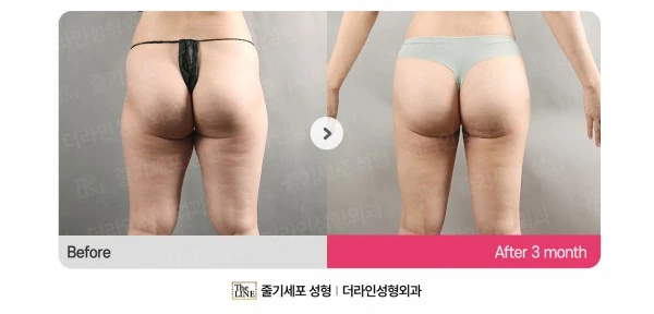 Hip Fat Grafting before-and-after photo, before surgery - TheLINE Plastic Surgery