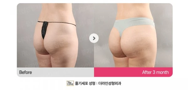 Hip Fat Grafting before-and-after photo, before surgery - TheLINE Plastic Surgery