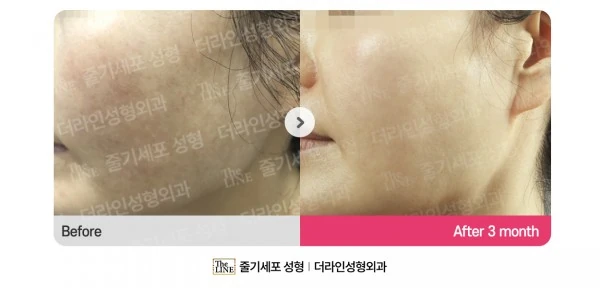 Stem Cell Melasma Treatment before-and-after photo, before surgery - TheLINE Plastic Surgery