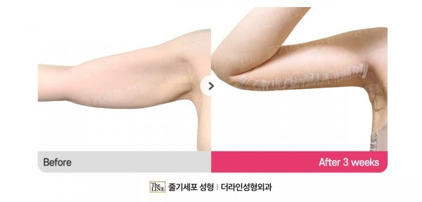 Arm Lift before-and-after photo, before surgery - TheLINE Plastic Surgery