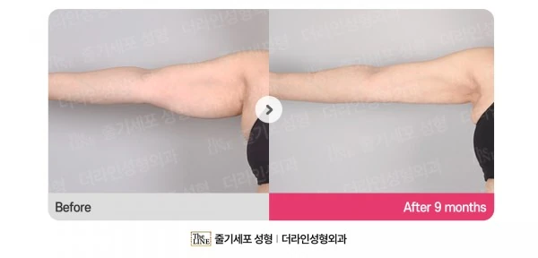 Arm Lift before-and-after photo, before surgery - TheLINE Plastic Surgery
