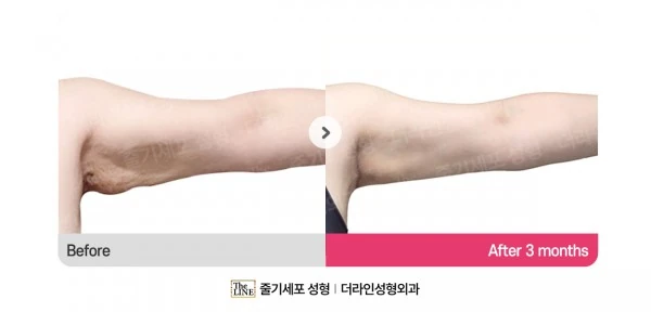 Arm Lift before-and-after photo, before surgery - TheLINE Plastic Surgery
