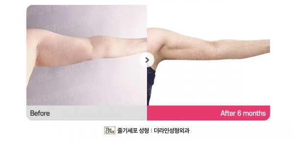 Arm Lift before-and-after photo, before surgery - TheLINE Plastic Surgery