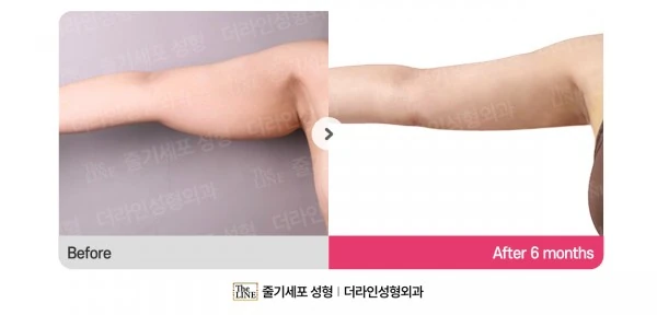 Arm Lift before-and-after photo, before surgery - TheLINE Plastic Surgery