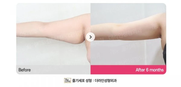 Arm Lift before-and-after photo, before surgery - TheLINE Plastic Surgery