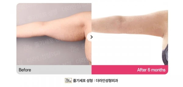 Arm Lift before-and-after photo, before surgery - TheLINE Plastic Surgery