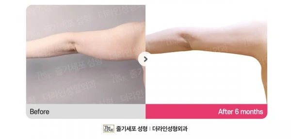 Arm Lift before-and-after photo, before surgery - TheLINE Plastic Surgery