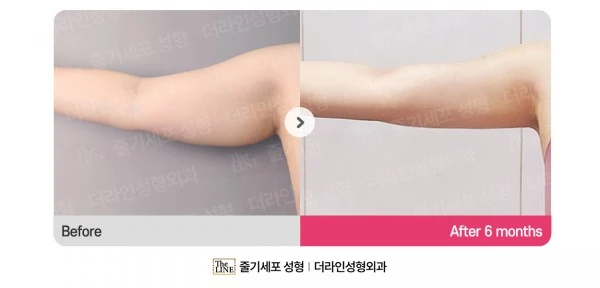 Arm Lift before-and-after photo, before surgery - TheLINE Plastic Surgery