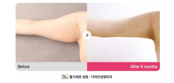 Arm Lift before-and-after photo, before surgery - TheLINE Plastic Surgery